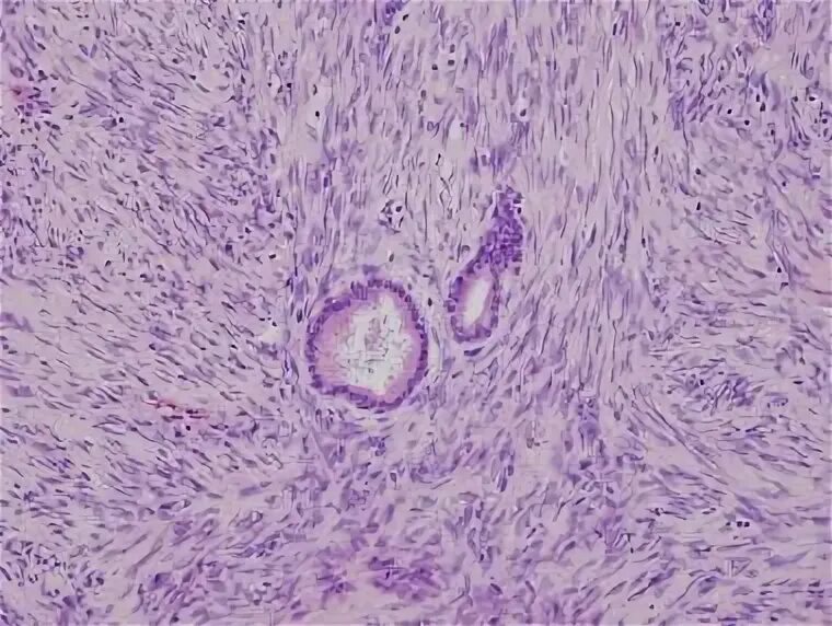 Стромальная саркома. Эндометриальная стромальная саркома матки. Эндометриальная стромальная саркома гистология. Стромальная саркома матки гистология. Эндометриальная саркома матки гистология.