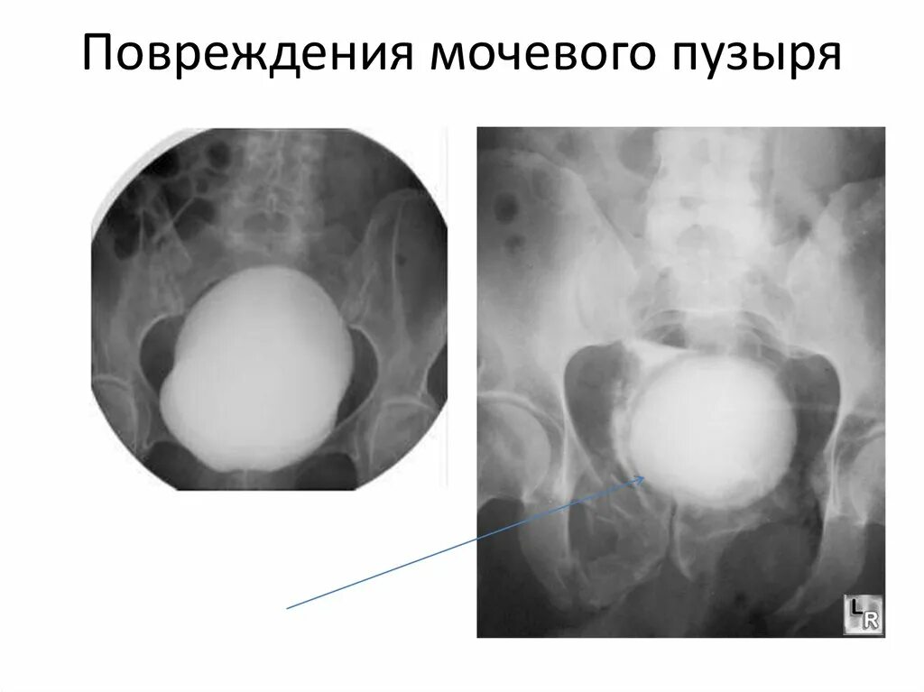 Внутрибрюшинный разрыв мочевого пузыря рентген. Цистография разрыв мочевого пузыря. Травма слизистой оболочки мочевого пузыря. Травматические повреждения мочевого пузыря.