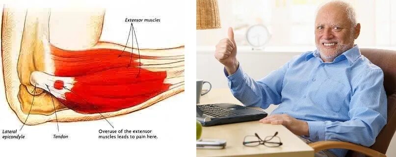 Локоть теннисиста латеральный эпикондилит. Эпикондилит локтевого сустава психосоматика. Дипроспан энтезопатия латеральный эпикондилит. Симптомы эпикондилита локтевого сустава. Боль в локте какой врач