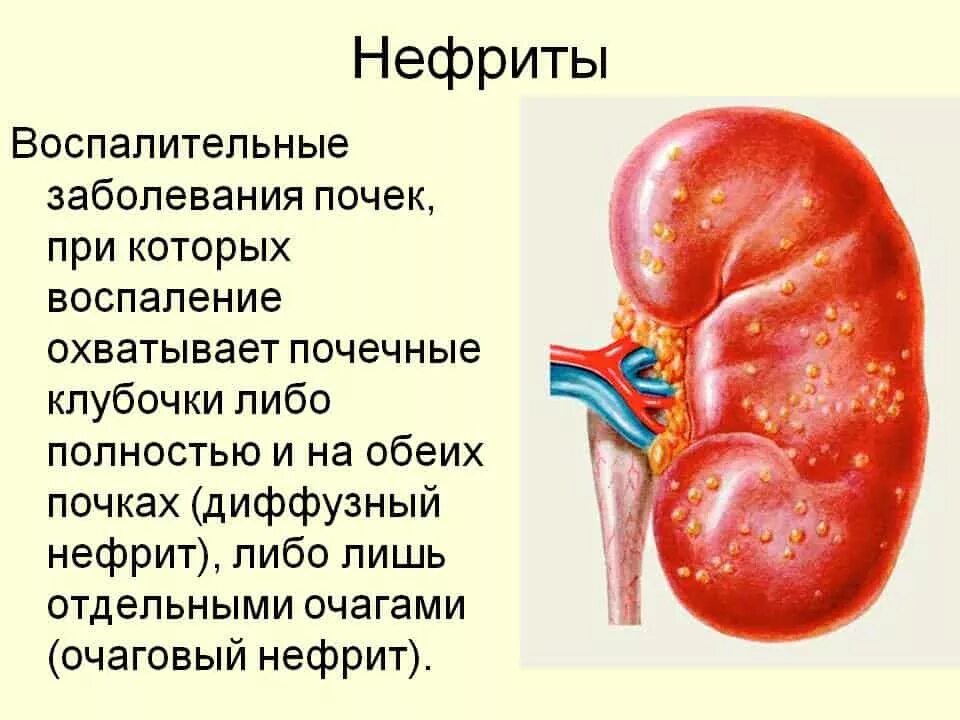 Нефрит ,пиелонефрит почек. Воспалительные заболевания почек пиелонефрит. Нефрит воспаление почек. Лечение печени почек