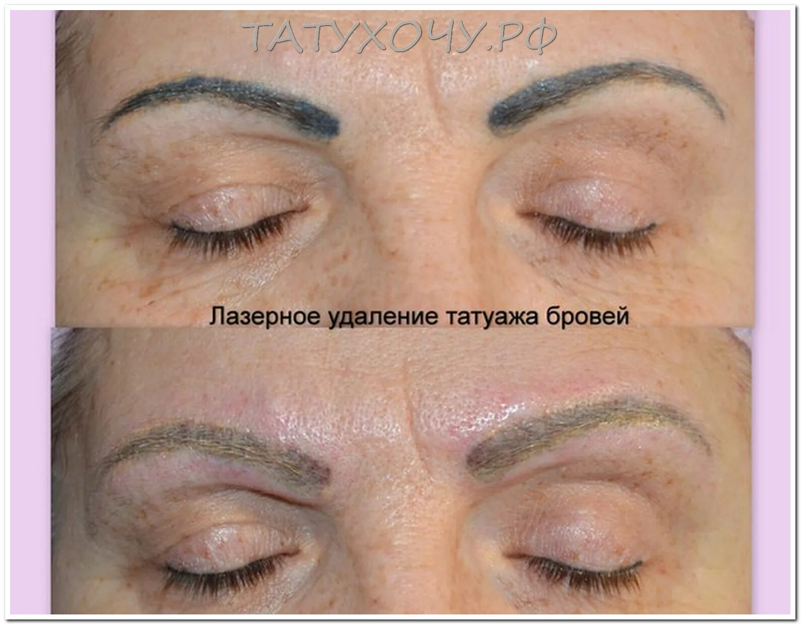 выведение перманентного макияжа бровей. заживление перманентного макияжа. татуаж после ремувера. выведение татуажа лазером. брови после лазера.