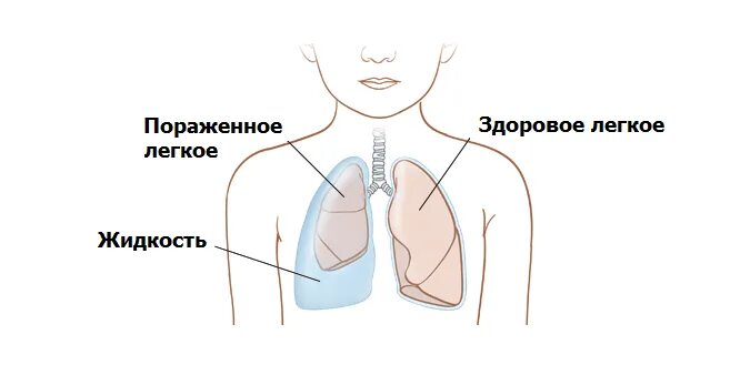 Скопление воды в легких. Попадание жидкости в легкие. Немного воды в легких