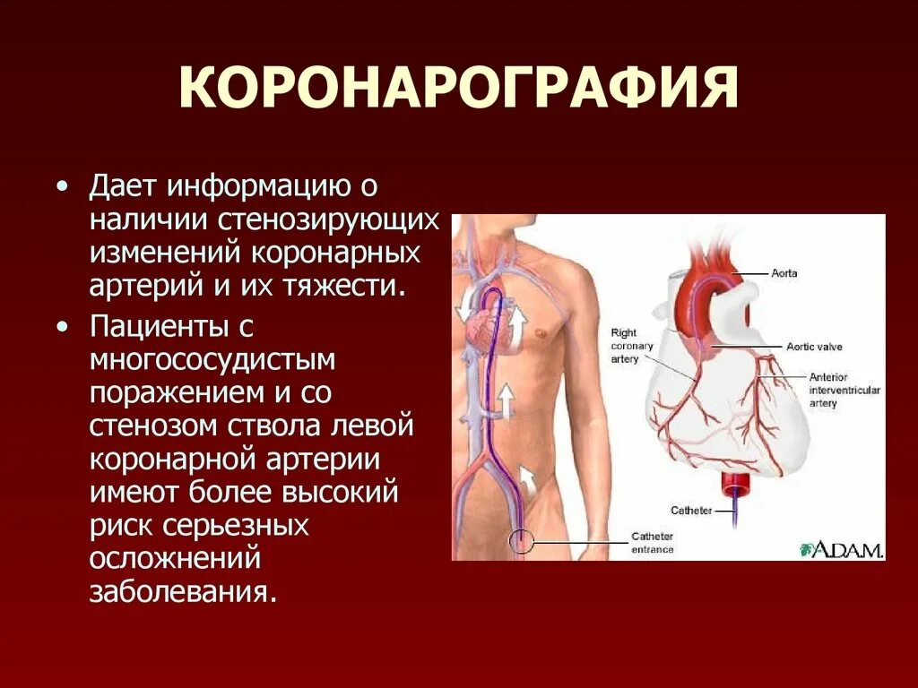 Коронарные осложнения. Метод проведения коронарография. Метод исследование коронарография. Коронарография сердца. Что такое коронарка сосудов сердца.