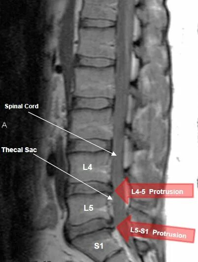 Протрузия диска на уровне l5 s1. Диски l5-s1 в позвоночнике. Протрузия диска l2-l3. Протрузия межпозвонковых дисков l1/l2,l4-s1. Грыжа l1/l2 l2/l3 l3/l4 l5/s1.