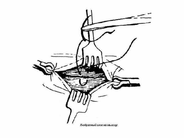 Х образный шов. Соединение тканей топографическая анатомия. П образный хирургический шов. Техника зашивания операционной раны.