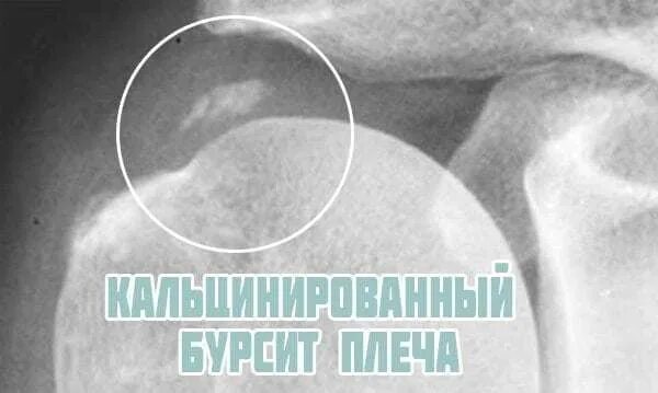 Почему опухло плечо