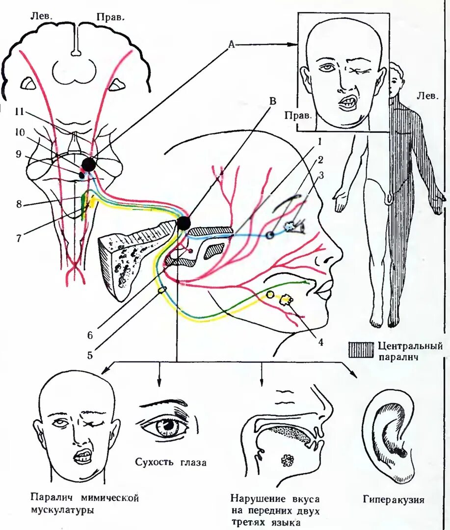 Лицевой нерв неврология схема. Топическая диагностика поражения лицевого нерва на разных уровнях. Поражение лицевого нерва неврология. Ядра лицевого нерва схема. Центральный парез лицевого нерва