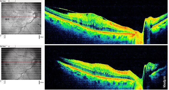 Эпиретинальный фиброз глаза. Эпималекулярный фиброз. Эпиретинальный фиброз. Эпиретинальный фиброз окт. Эпимакулярный фиброз глаза что это.