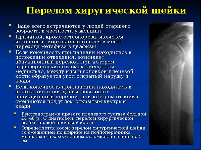 Как лечить перелом плеча у пожилых. Аддукционный перелом плечевой кости рентген.