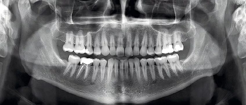 Снимок зубов видное. Ортопантомограмма челюсти. Ортопантомограмма пародонтит. Ортопантомография (ОПТГ). Ортопантомограмма периостит.