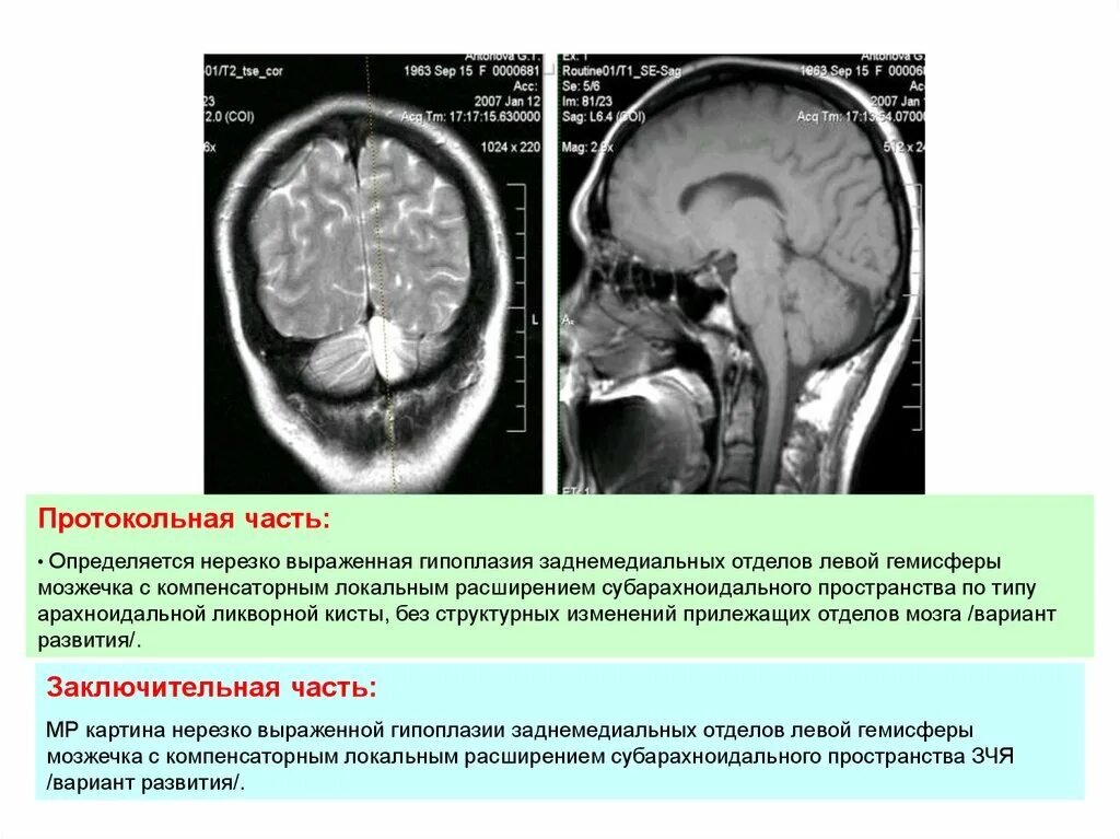 Умеренно расширение конвекситальных пространств