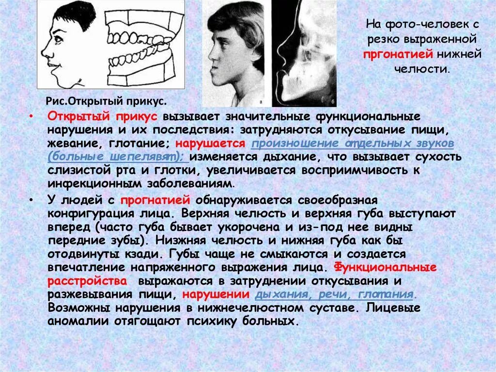 Патология нижней челюсти. Девиация височно-нижнечелюстного сустава. Свело челюсть при зевании.