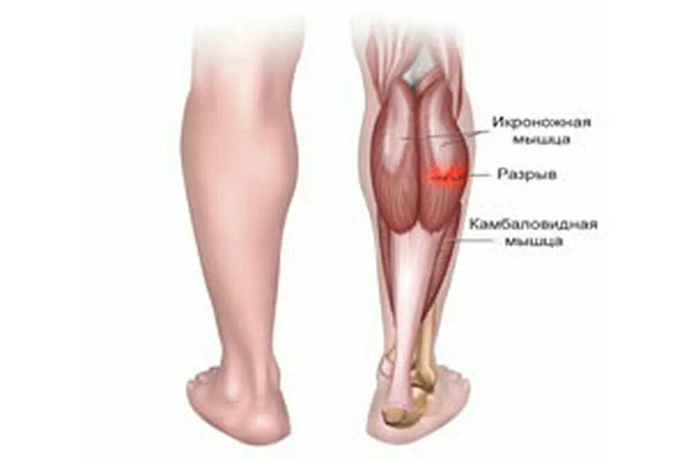 Боль в икрах ног причины у мужчин. Голень ноги. Икры ног.