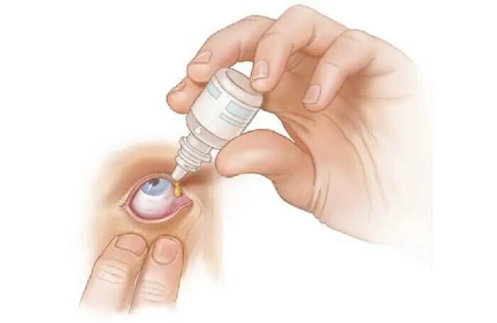 Закапывание глазных капель в конъюнктивальный мешок. Закапывание глазных капель в конъюнктивальный мешок алгоритм. Введение капель в конъюнктивальный мешок. Капает в глаза. Как часто можно капать капли