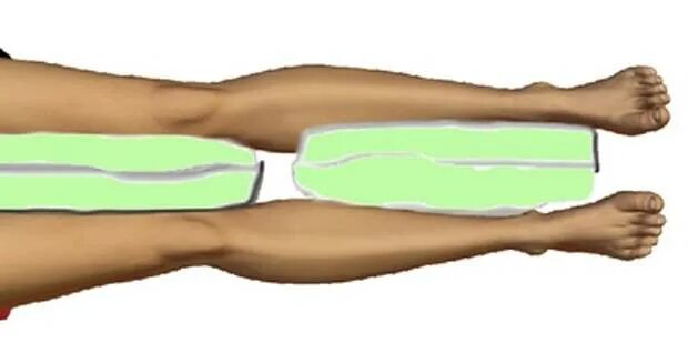 Можно ли спать на боку после операции. Подушка между после эндопротезирования тазобедренного. Валик после эндопротезирования тазобедренного сустава. Подушка между ног после эндопротезирования тазобедренного сустава. Валик между ног после эндопротезирования тазобедренного.