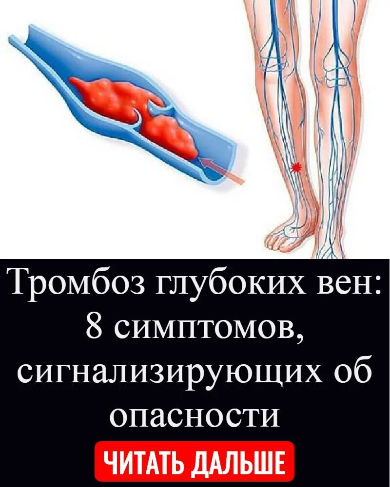 Тромбофлебит флеботромбоз флебит тромбоз. Как снизить тромбоз