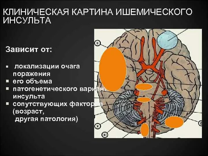 Левая средняя мозговая артерия инсульт. Ишемический инсульт головного мозга клиника. Ишемический инсульт поражение средней мозговой артерии. Инсульт в средней мозговой артерии клиника. Ишемический инсульт очаг поражения.