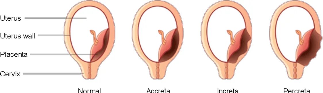 Плацента на рубце матки. Плацента инкрета перкрета. Placenta percreta характеризуется. Плацента плотное прикрепление placenta Accreta increta.