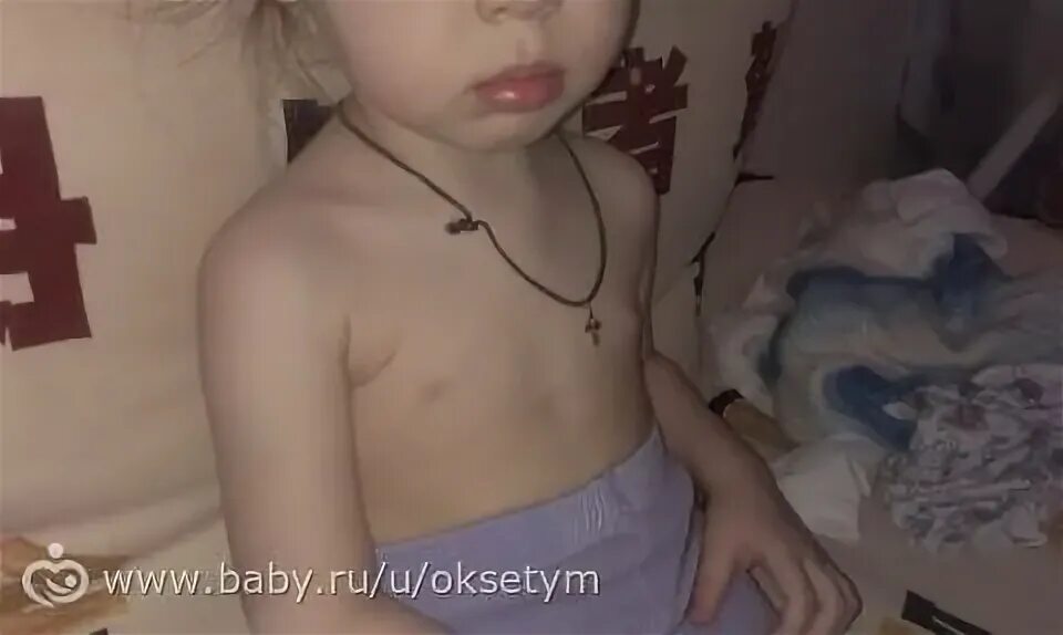 У девочки 9 лет набухла. Менархе телархе пубархе. раннее телархе у девочки. изолированный телархе.