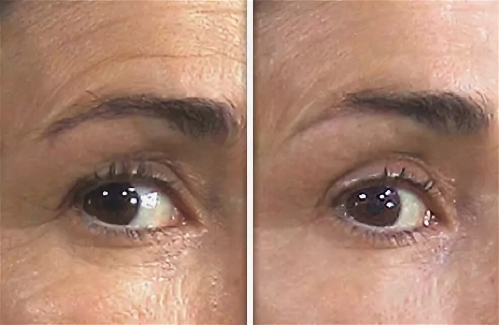 Lpg лица до и после Ellen's Backstage Skincare Secret Her Anti-Aging Trick Finally Exposed! Skin c
