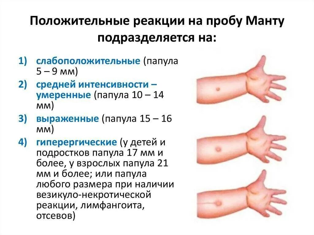 Реакция манту размеры норма у детей. Реакция манту норма у детей 12 лет. реакции манту папулы норма. туберкулиновая проба манту норма. туберкулиновая проба диаскинтест нормы.