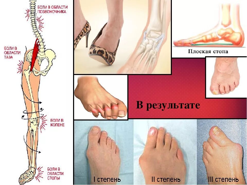 Стопы при плоскостопии. Стопа плоскостопие. Болят стопы при плоскостопии. Болят ноги при плоскостопии.