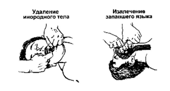 Западения корня языка. Предотвращение западения языка. прием сафара при сердечно легочной реанимации. западение языка у ребенка.