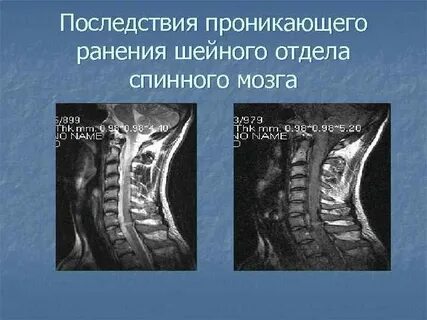 Повреждения позвоночника и спинного мозга