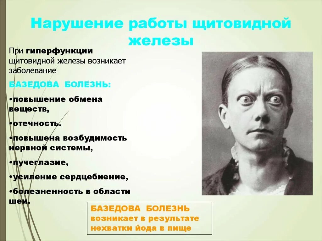 Клинические симптомы базедовой болезни. Базедова базедова болезнь. Гиперфункция щитовидной железы, базедова болезнь. Гиперфункция щитовидной железы зоб базедова болезнь. Заболевание при гиперфункции щитовидной