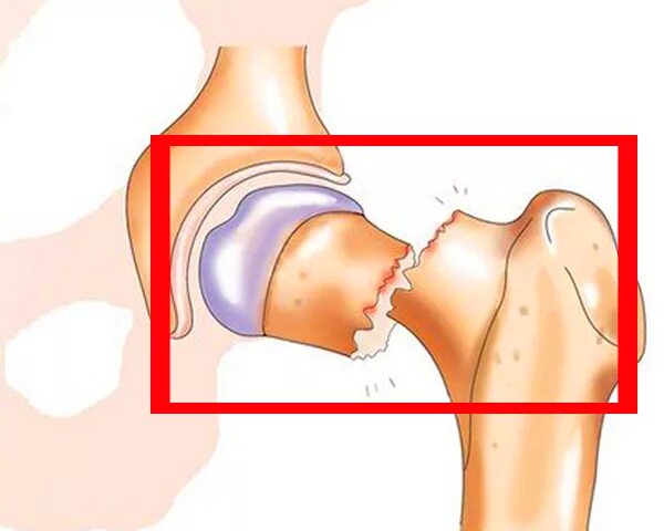 Медиальный перелом шейки бедра у пожилых. Бедренная кость хирургическая шейка. Тазобедренный сустав перелом шейки бедра. Перелом шейки бедренной кости со смещением у пожилых людей. Трещина шейки