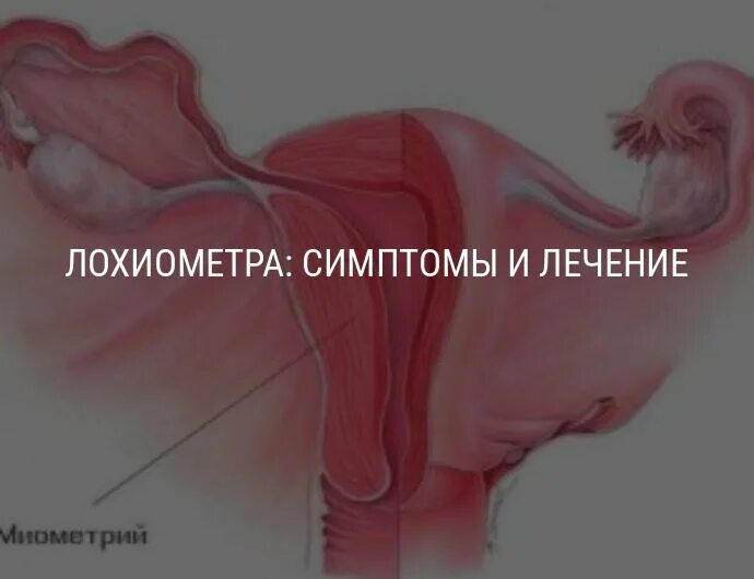 Лохии после родов сколько длятся. Лохиометра и гематометра. Послеродовая лохиометра. Послеродовой эндометрит и лохиометра.