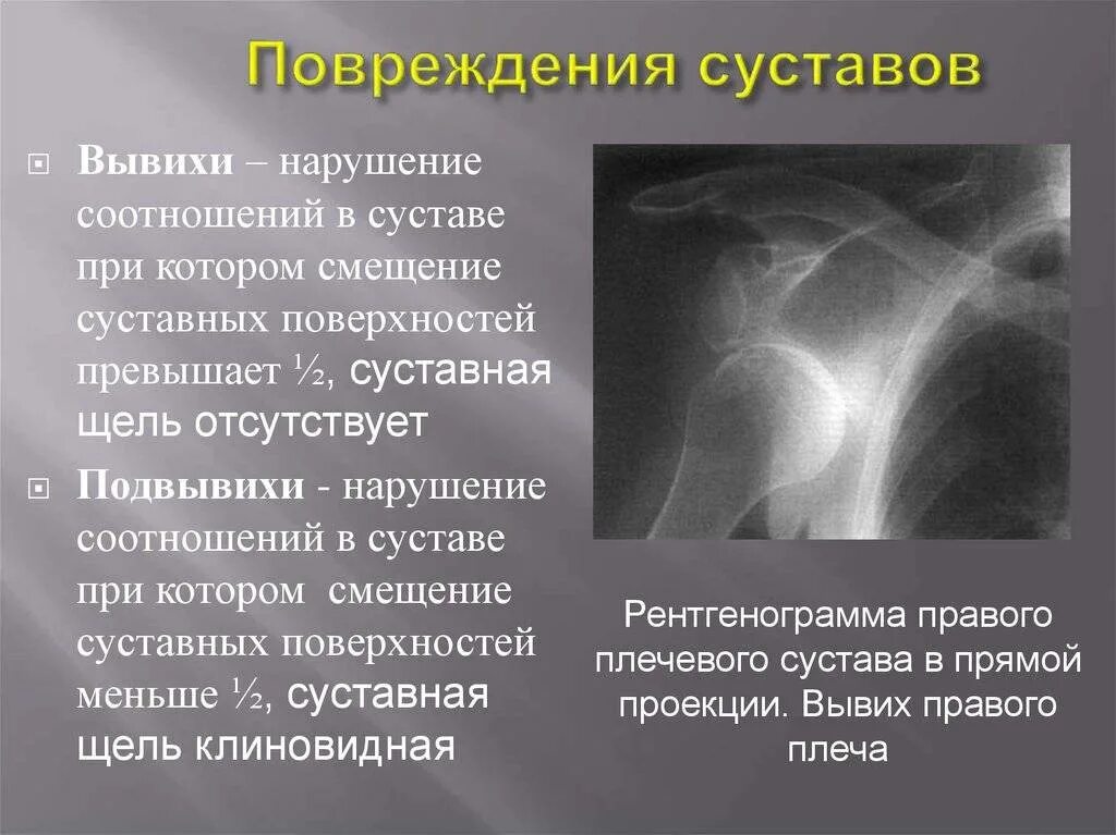 Подвывих по ковачу. Подвывих вывих плечевого сустава рентген. подвывих плечевого сустава рентген. подвывих правого плечевого сустава рентген. вывих плечевого сустава рентген.