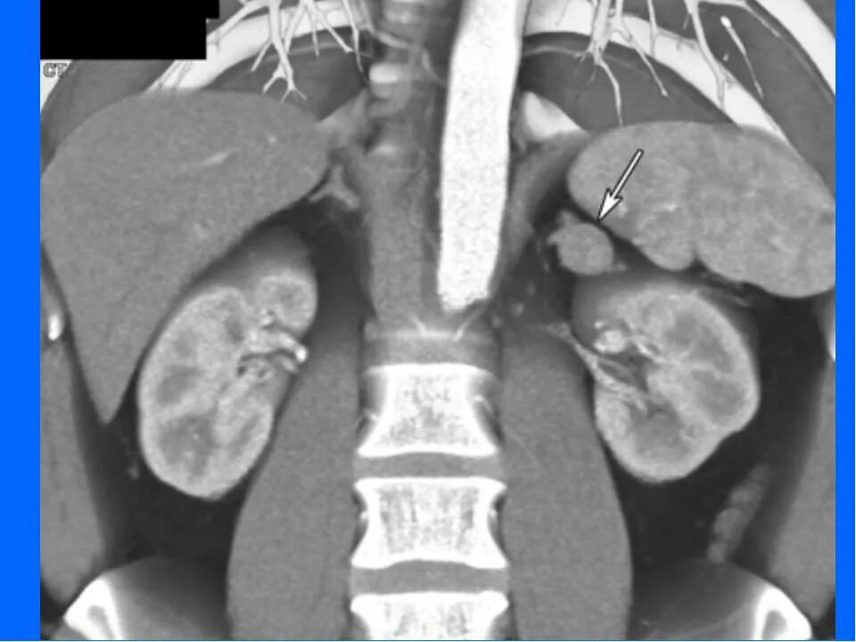 Микроаденома надпочечника кт. Гиперплазия надпочечников на кт. Гипертрофия надпочечников на кт. Кт мрт аденома надпочечника. Аденома надпочечника у мужчин что это