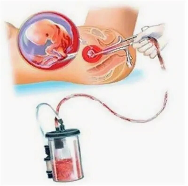 Вакуумное прерывание беременности после. Вакуумная оперция матки. Вакуум аспирация выкидыш. Вакуумная аспирация матки замершей беременности. Вакуумная аспирация плодного яйца.