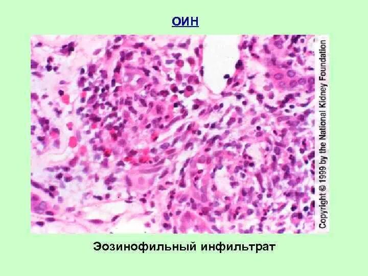 Эозинофильная инфильтрация легких рентген. Эозинофильный инфильтрат. Эозинофильный инфильтрат. Летучий эозинофильный инфильтрат. Аскаридоз рентген легких синдром леффлера.