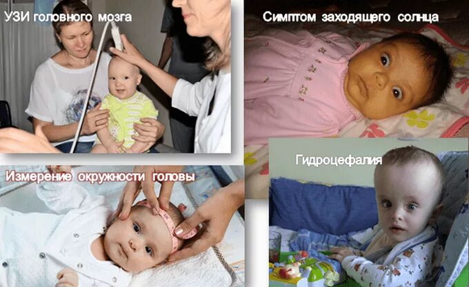 Внутричерепное давление симптомы у детей. Синдром внутричерепного давления у грудничков. внутричерепное давление у новорожденных симптомы. вчд у грудничка симптомы. признаки черепного давления у младенцев.