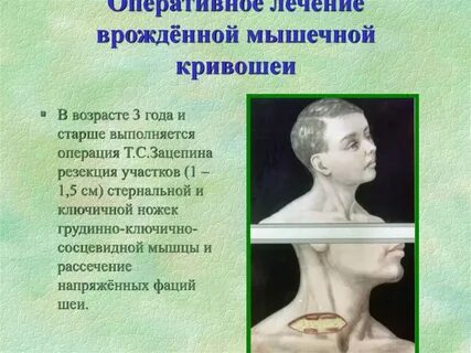 Врожденная мышечной