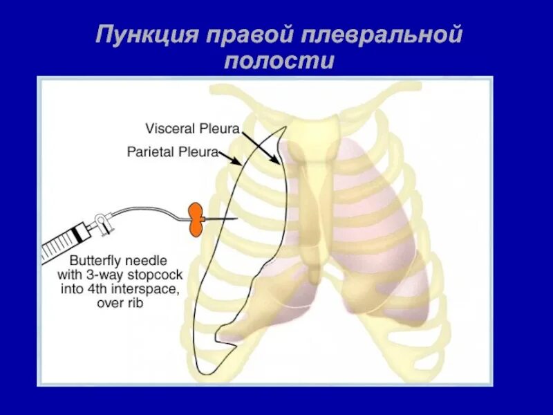 Пункция экссудата. Пункция плевральной полости ребро. плевральная пункция при пневмотораксе алгоритм. места пункции плевральной полости.