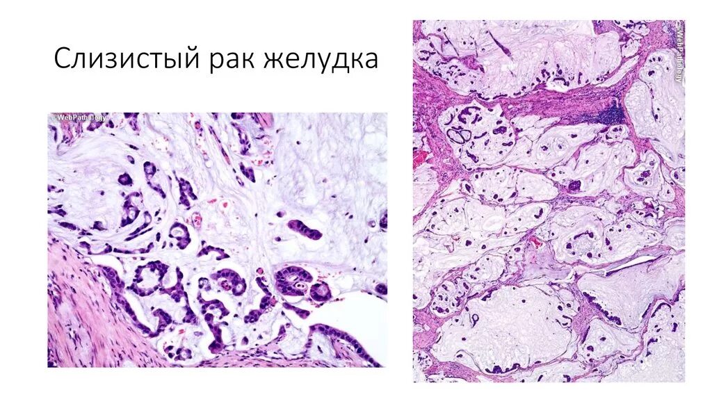 Аденокарцинома желудка гистология. Аденокарцинома кишечника гистология. Скирр желудка гистология. Аденокарцинома желудка макропрепарат.