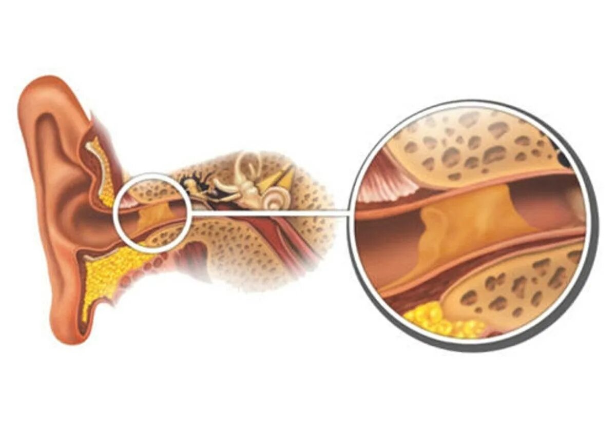 Серная пробка наружного слухового прохода. Отомикоз серная пробка. Строение уха человека серная пробка. Анатомия уха серная пробка.