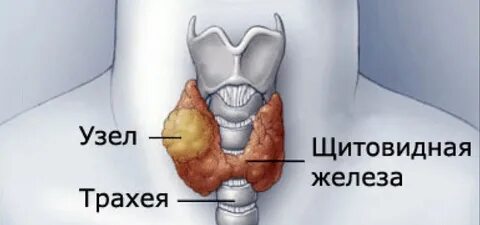 Узел щитовидки без операции