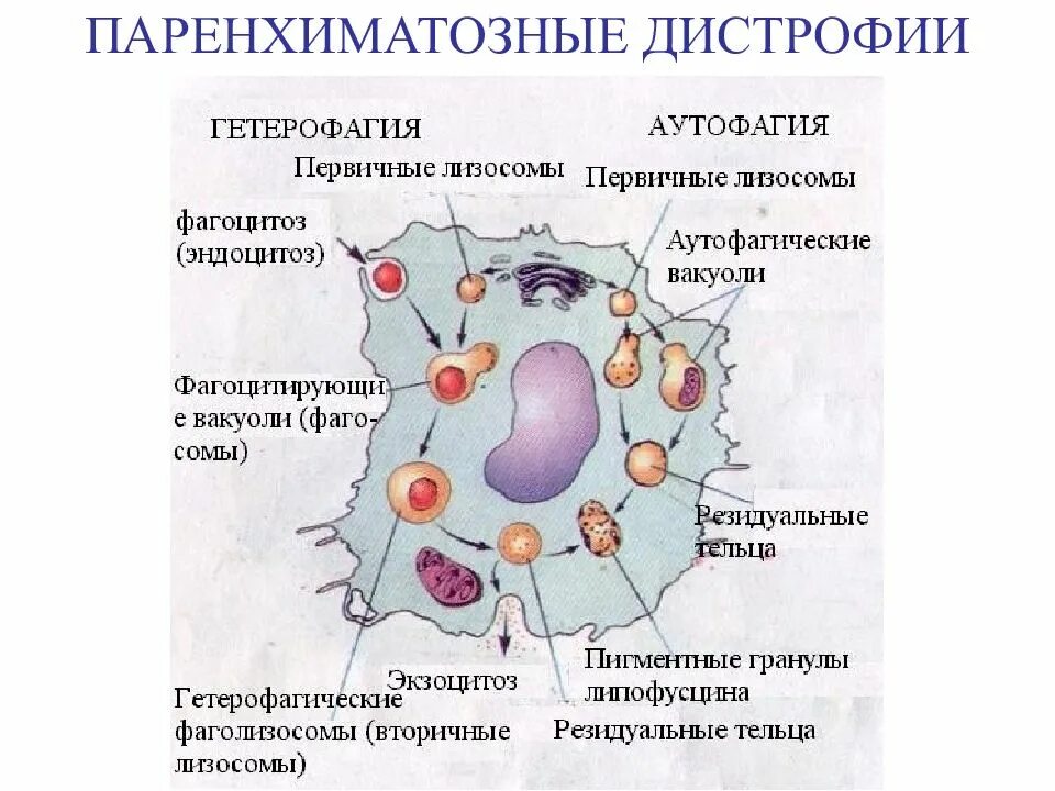 Механизм развития паренхиматозных дистрофий. Схема белковые дистрофии. Паренхиматозная дистрофия схема клетки. Паренхимаиозные дистрофия.