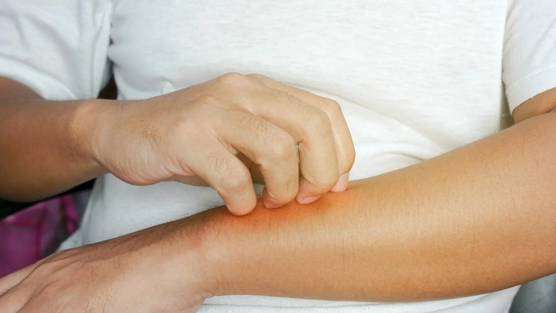 Дерматит на локтевых сгибах. Нажимаю на кожу. Нажимаю на кожу. Нажимаю на кожу. Нажимаю на кожу.