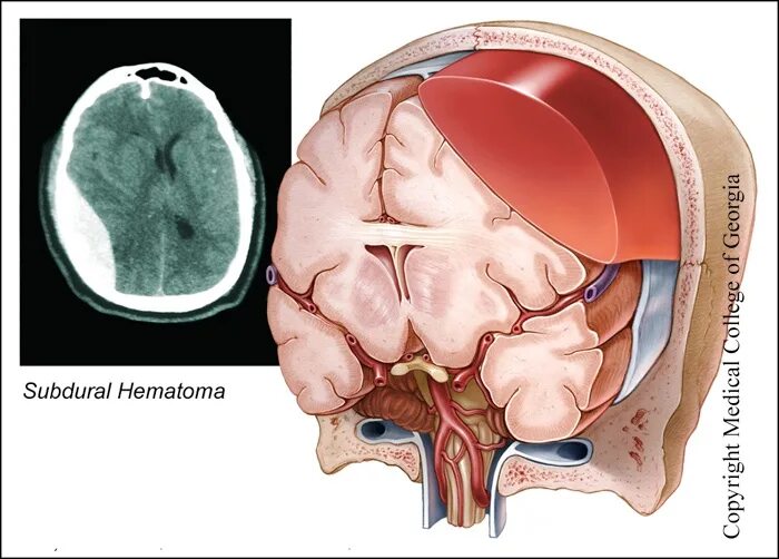Черепно мозговые гематомы. Черепно мозговая травма ушиб. Черепно-мозговая травма сдавление головного мозга. Закрытая черепно мозговая травма субдуральная гематома.