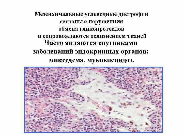 Мезенхимальные белковые. Мезенхимальные углеводные дистрофии. Стромально-сосудистые углеводные дистрофии. Слизистая паренхиматозная дистрофия. Мезенхимальные углеводные дистрофии. Этиология.