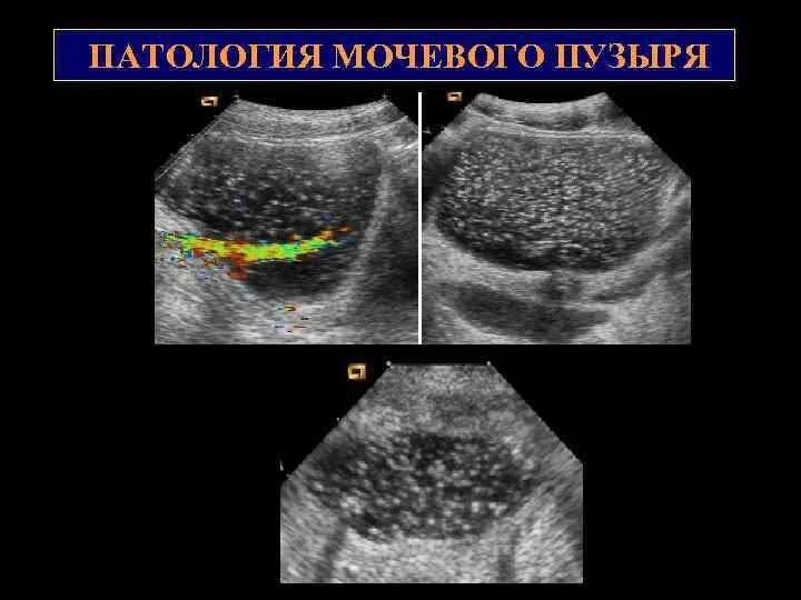 Аномалия мочевого. Ультразвуковая анатомия мочевого пузыря. Анатомия мочевого пузыря на УЗИ. УЗИ мочевого пузыря снимки. Цистит на УЗИ мочевого пузыря.