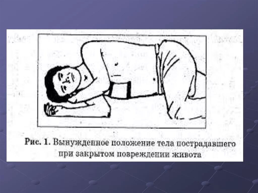 Положение пациента при осмотре. Положение пациента при аппендиците. положение пациента при остром аппендиците. вынужденное положение больного при остром животе. положение больного при остром аппендиците.