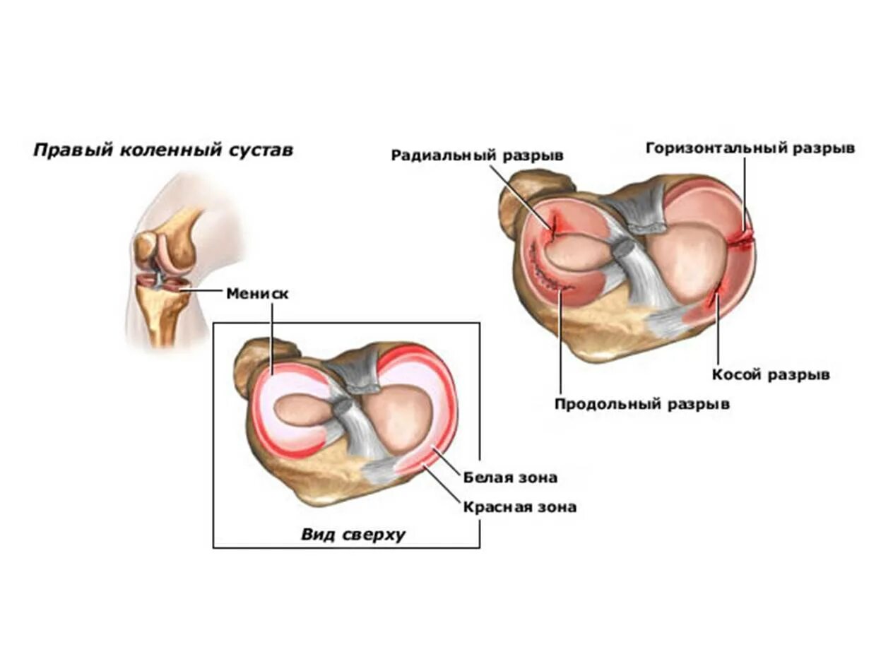Разрыв мениска коленного сустава. Повреждение разрыв медиального мениска коленного сустава. Мениски разрывы мениска коленного сустава. Медиальный мениск коленного сустава анатомия.