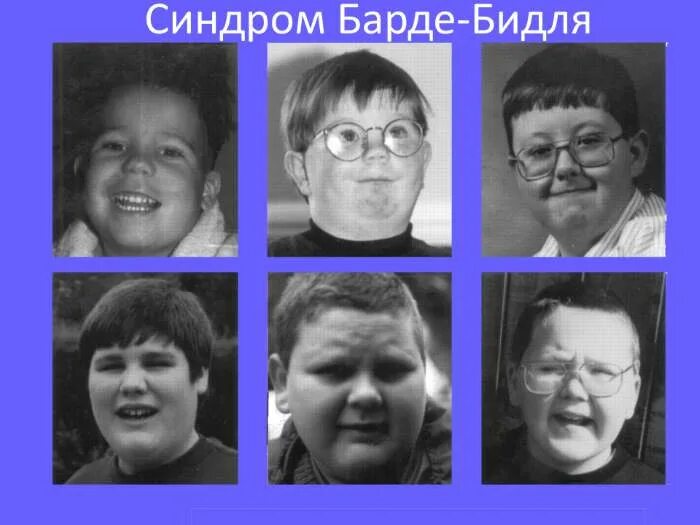 Синдром муна барде бидля. Синдром лоренса-муна-бидля-барде. синдром лоуренса барде бидля. родословная синдрома лоуренса муна барде бидля.