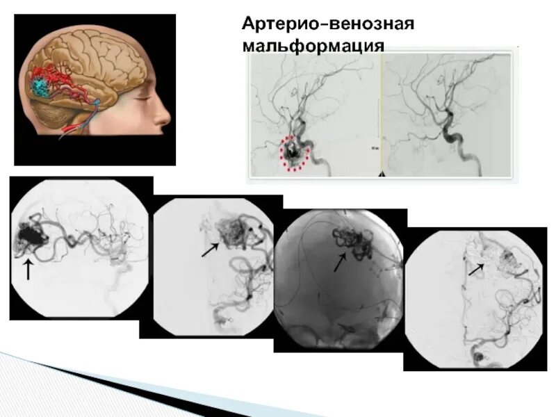 Что такое мальформация головного мозга. Венозная мальформация головного мозга. артериовенозная мальформация (авм). артериовенозная мальформация головного мозга. артериовенозная мальформация патанатомия.